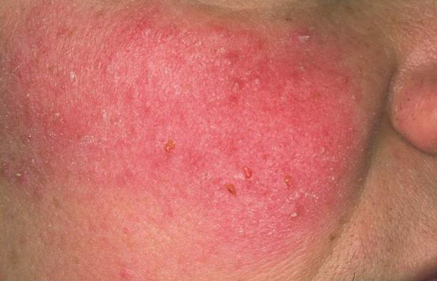 rosacea common skin condition