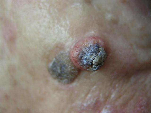 squamos cell carcinoma skin cancer