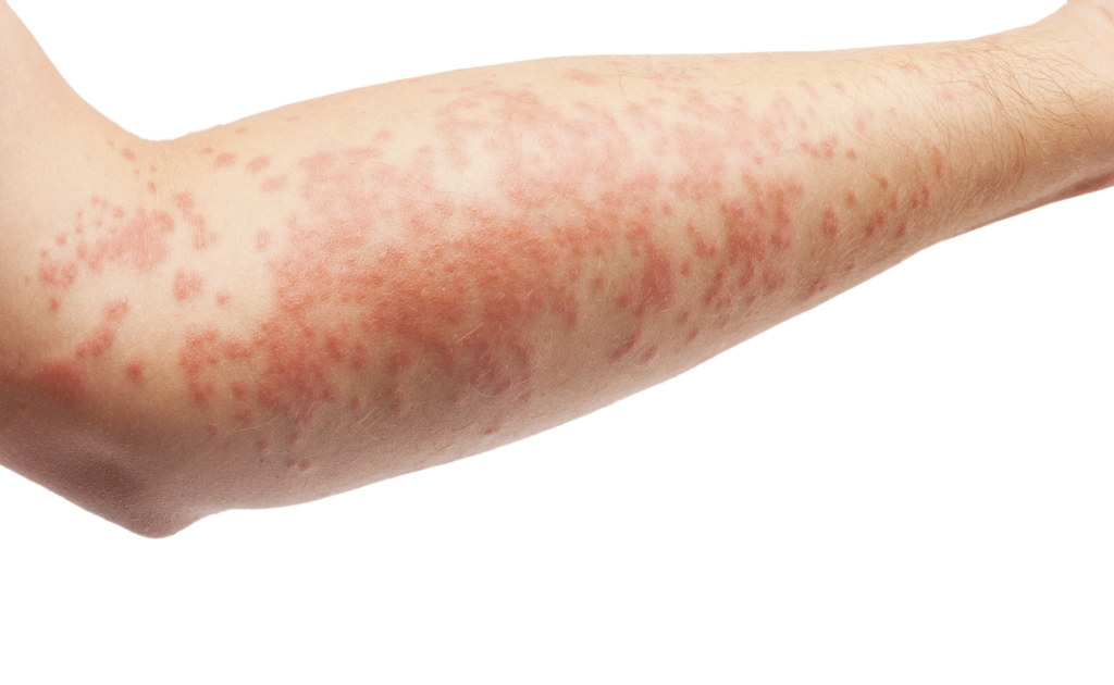 eczema on arm