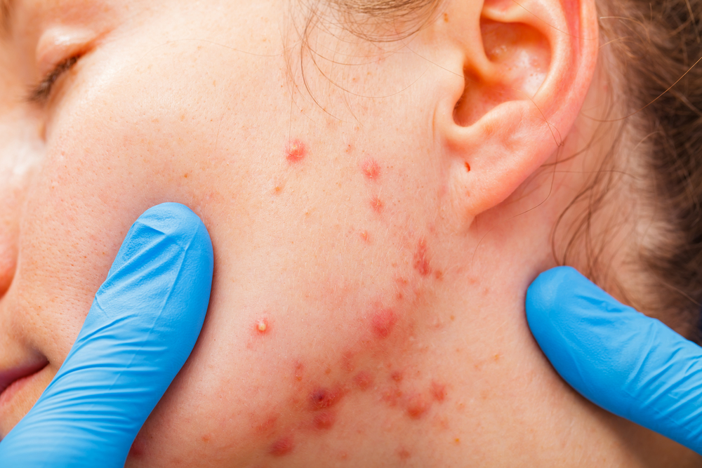 acne basics care treatments