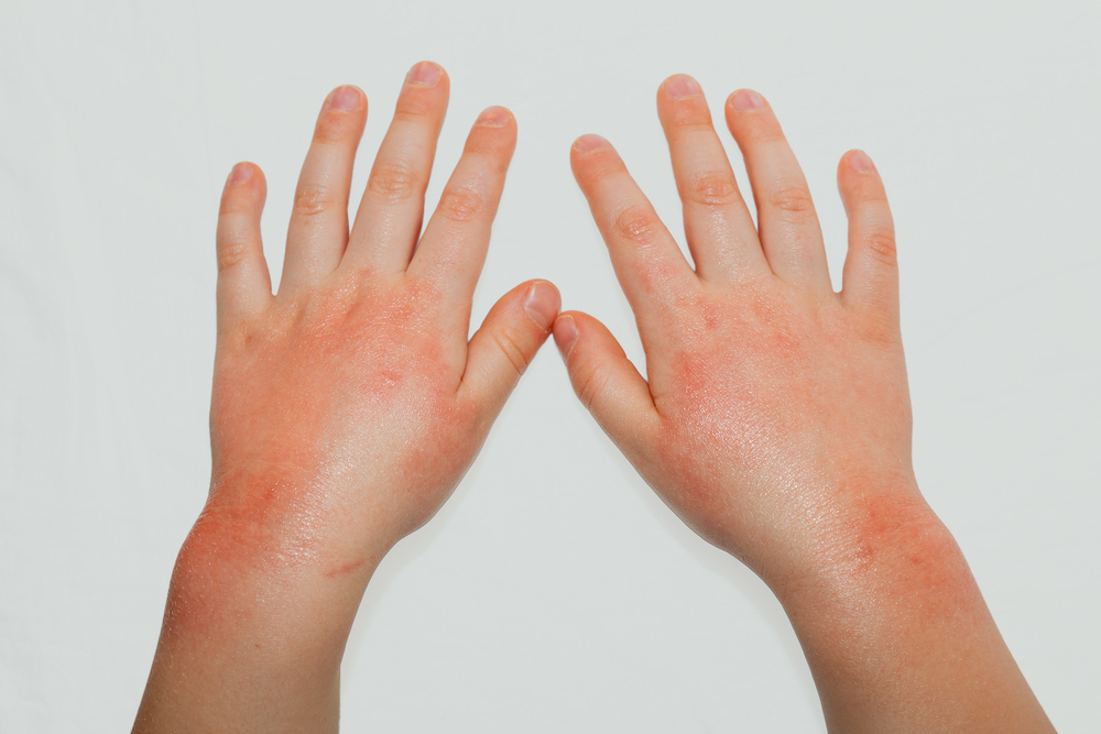 common skin condition eczema