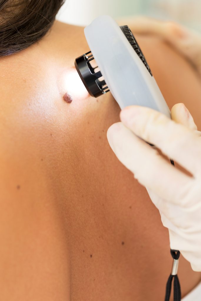 FBSE Full-Body Skin Evaluation Skin Cancer Screening with Dermatascope