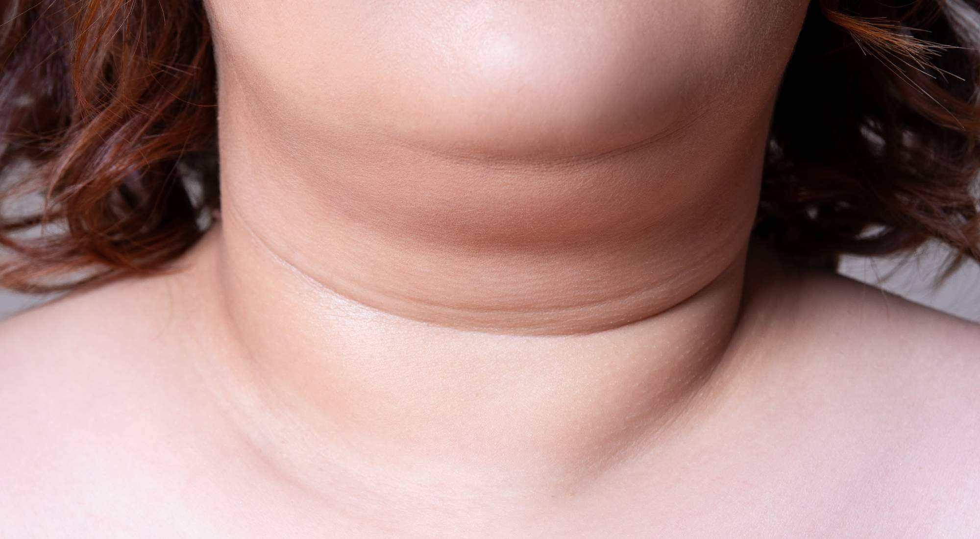 what is kybella